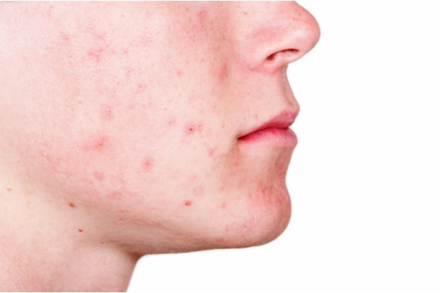 How will benzoyl peroxide becoming GSL affect your advice to patients?