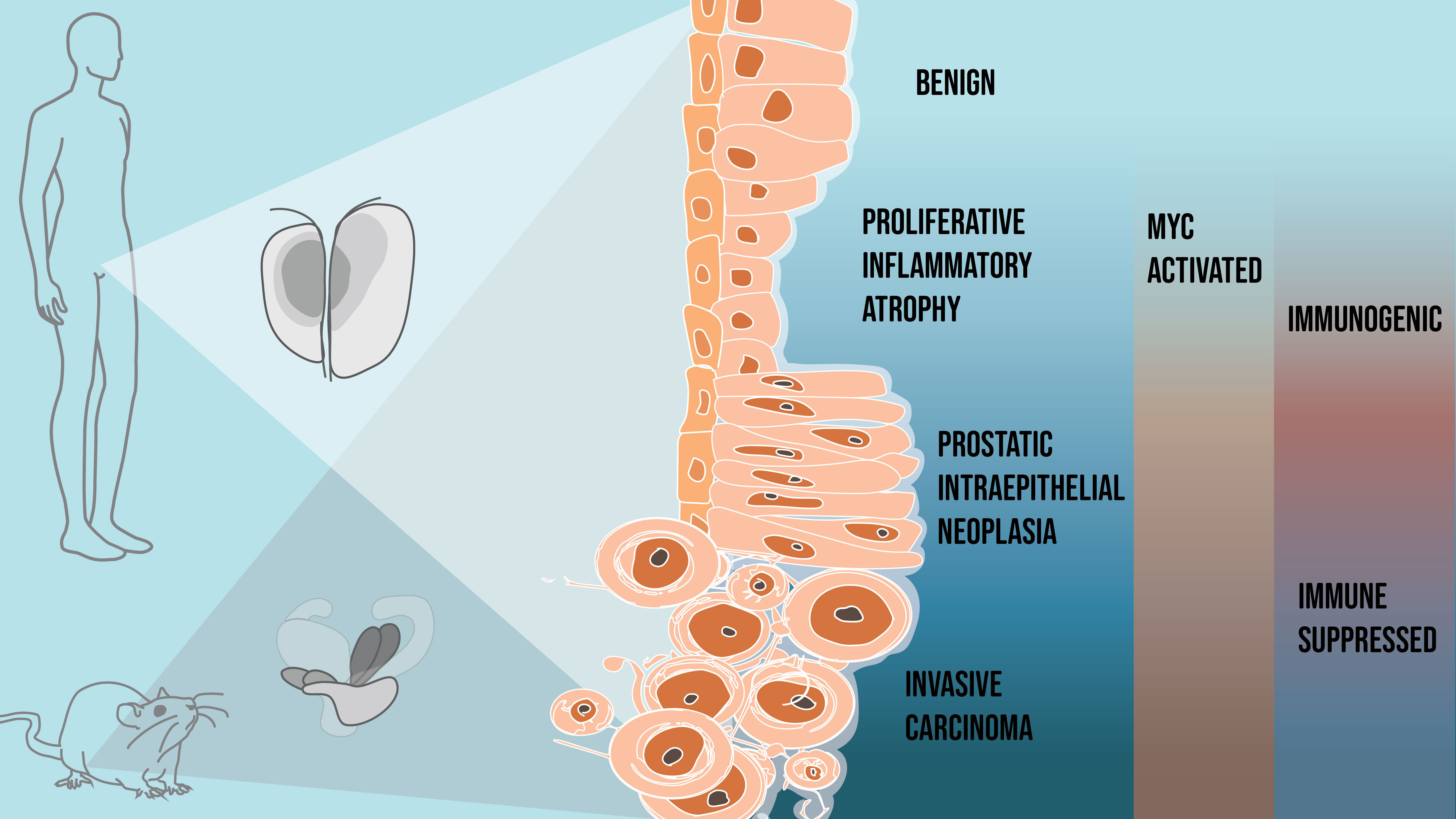 Navigating prostate cancer progression in humans 