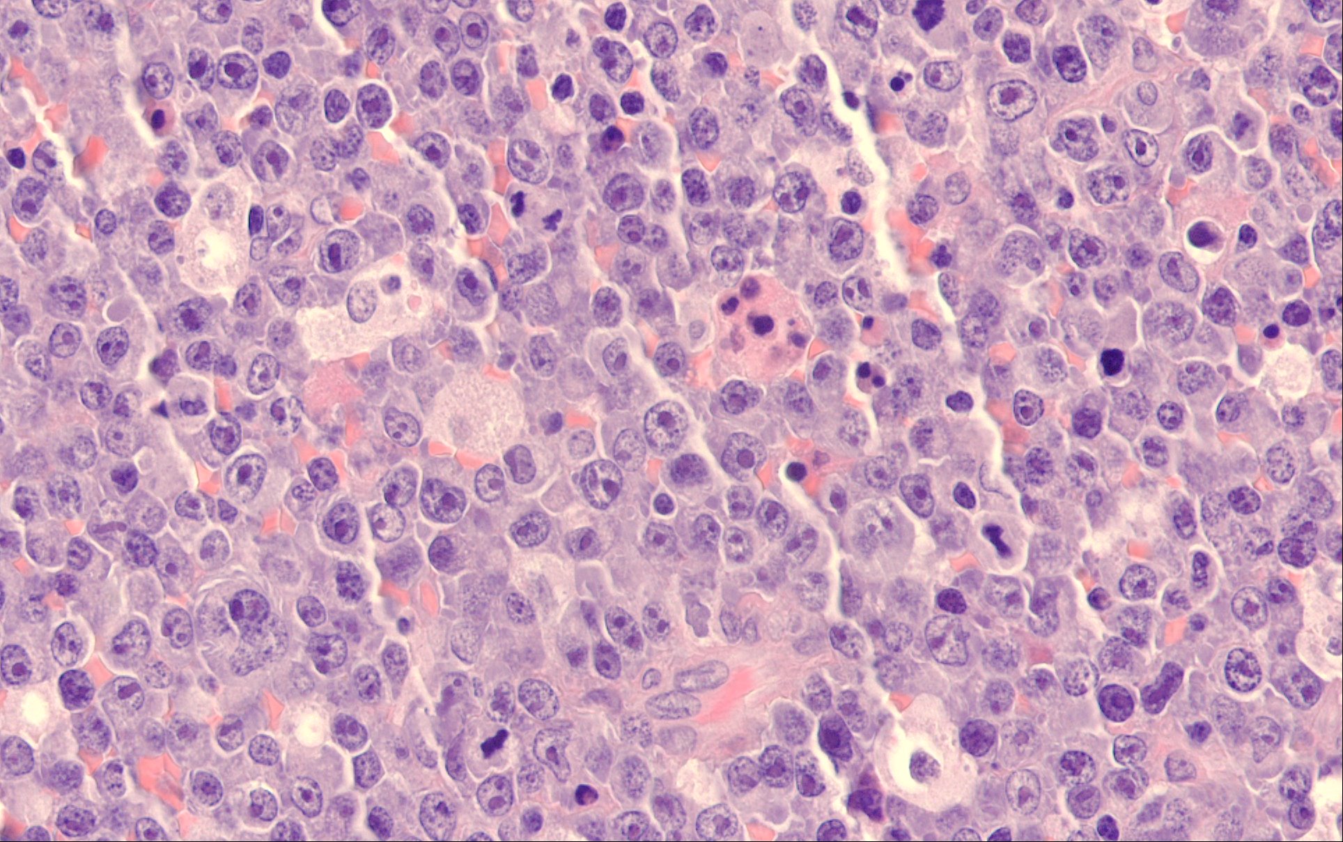 Molecular and functional profiling identifies therapeutically targetable vulnerabilities in plasmablastic lymphoma