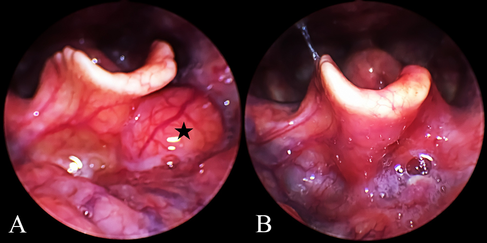 Behind the Paper: Revolutionizing Epiglottic Cyst Treatment with Videolaryngoscope-Assisted Coblation