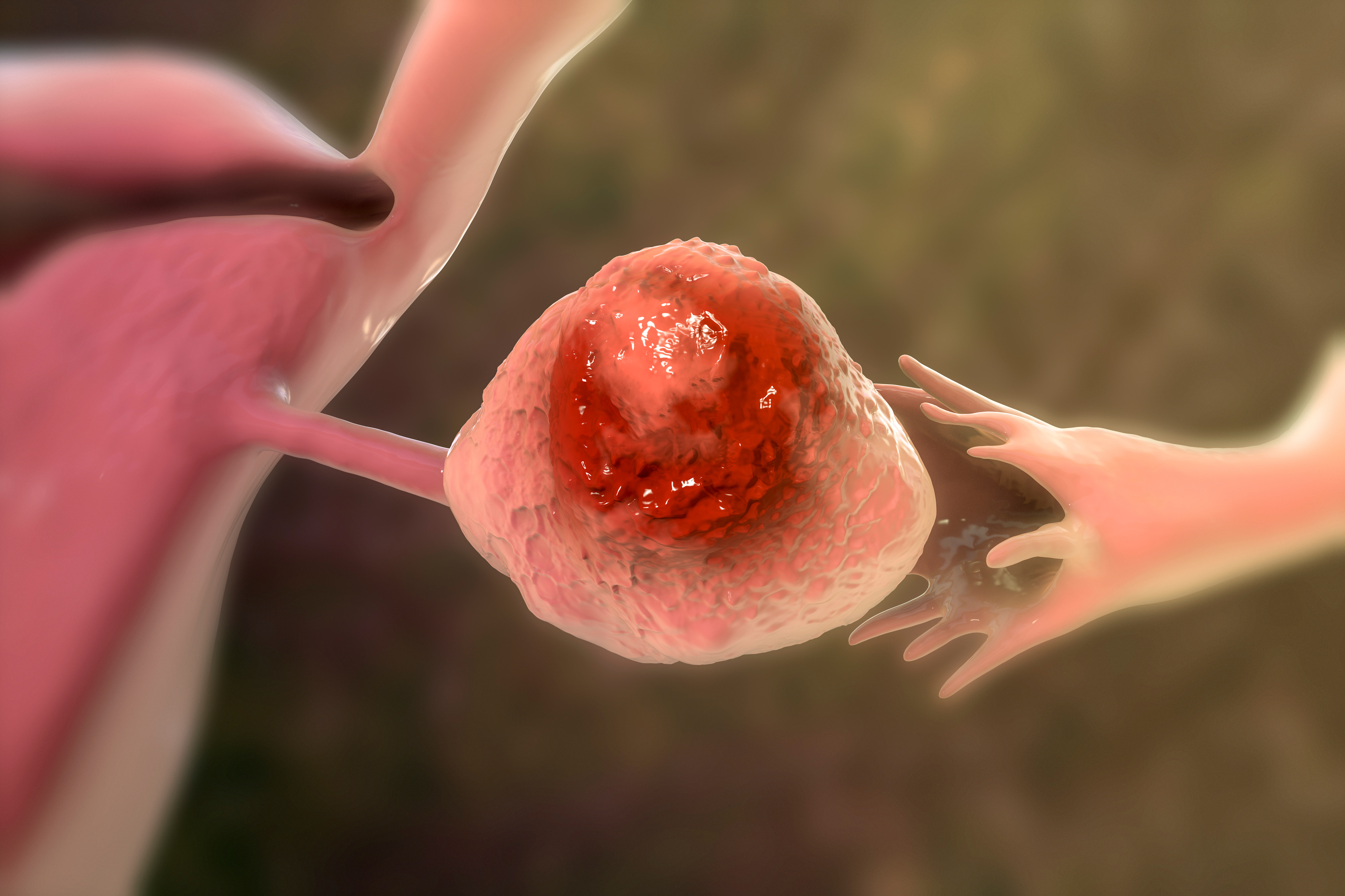 World Ovarian Cancer Day - Q&A with Dr Trevor Shepherd