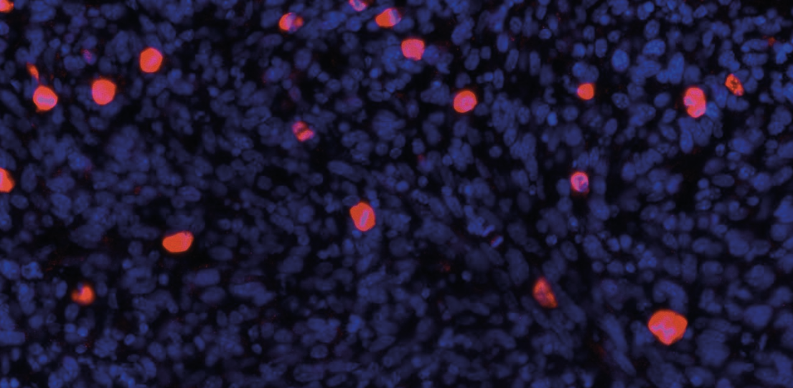 From chemotherapy resistance to immune escape: the evolving story of NCOR2