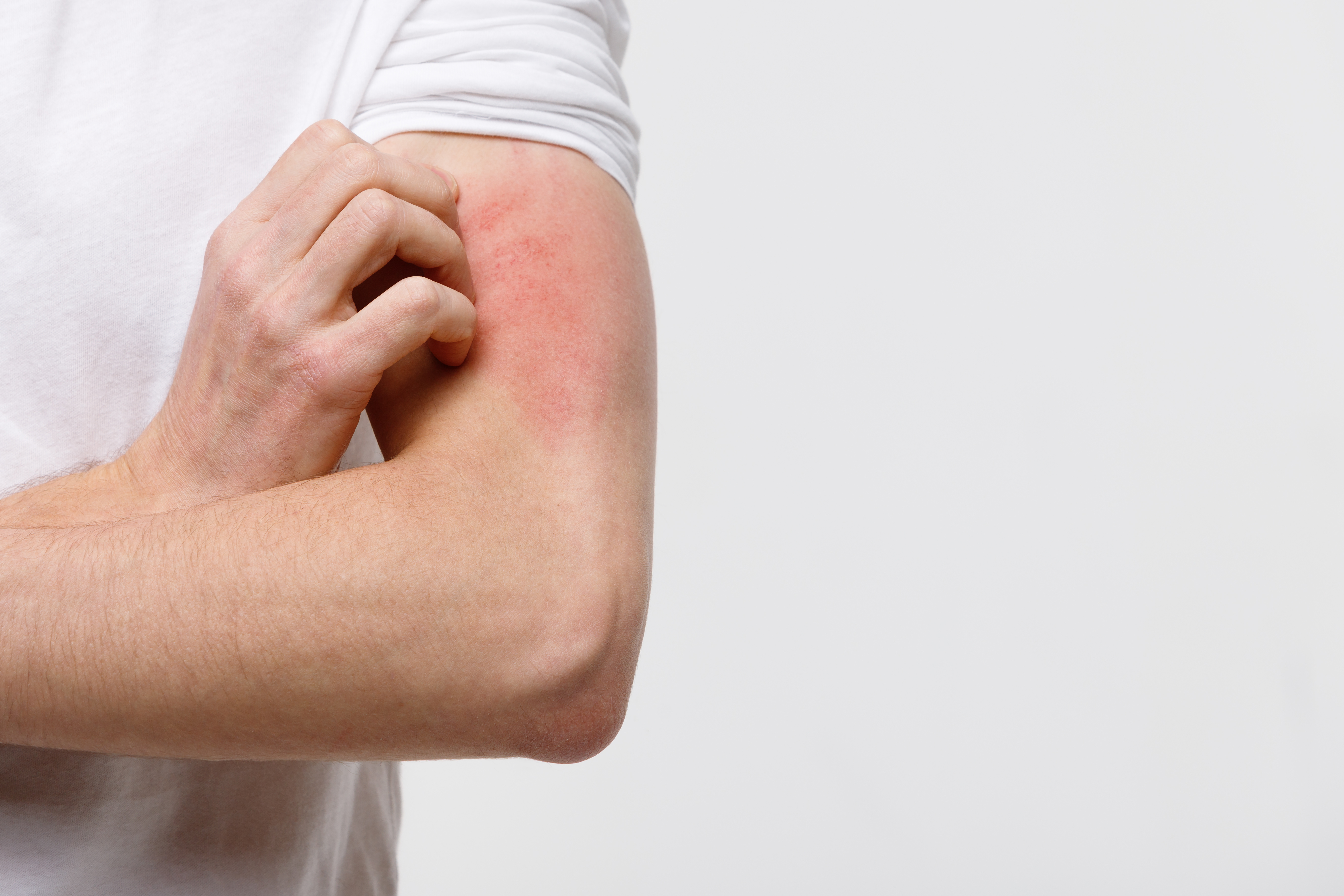 NephroBlog: Pruritus and Hemodialysis