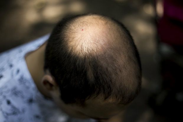 Common causes of hair loss