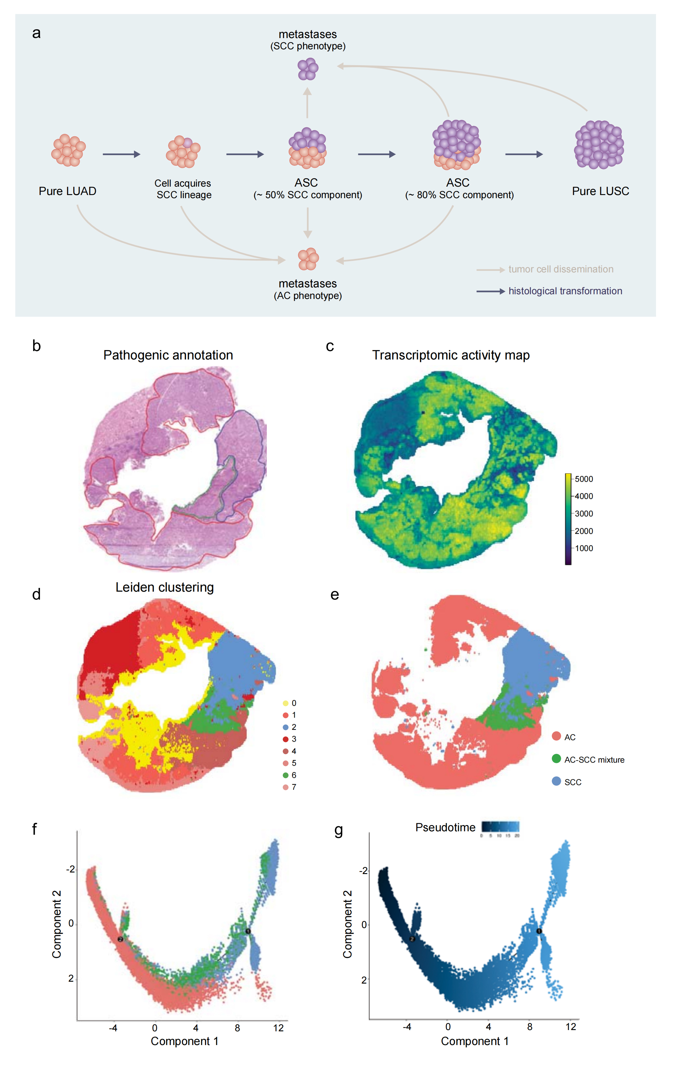 Clonal dynamics and stereo-seq resolve origin and phenotypic plasticity of adenosquamous carcinoma