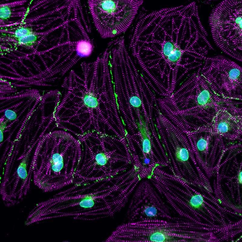 Human stem cells to model congenital heart disease