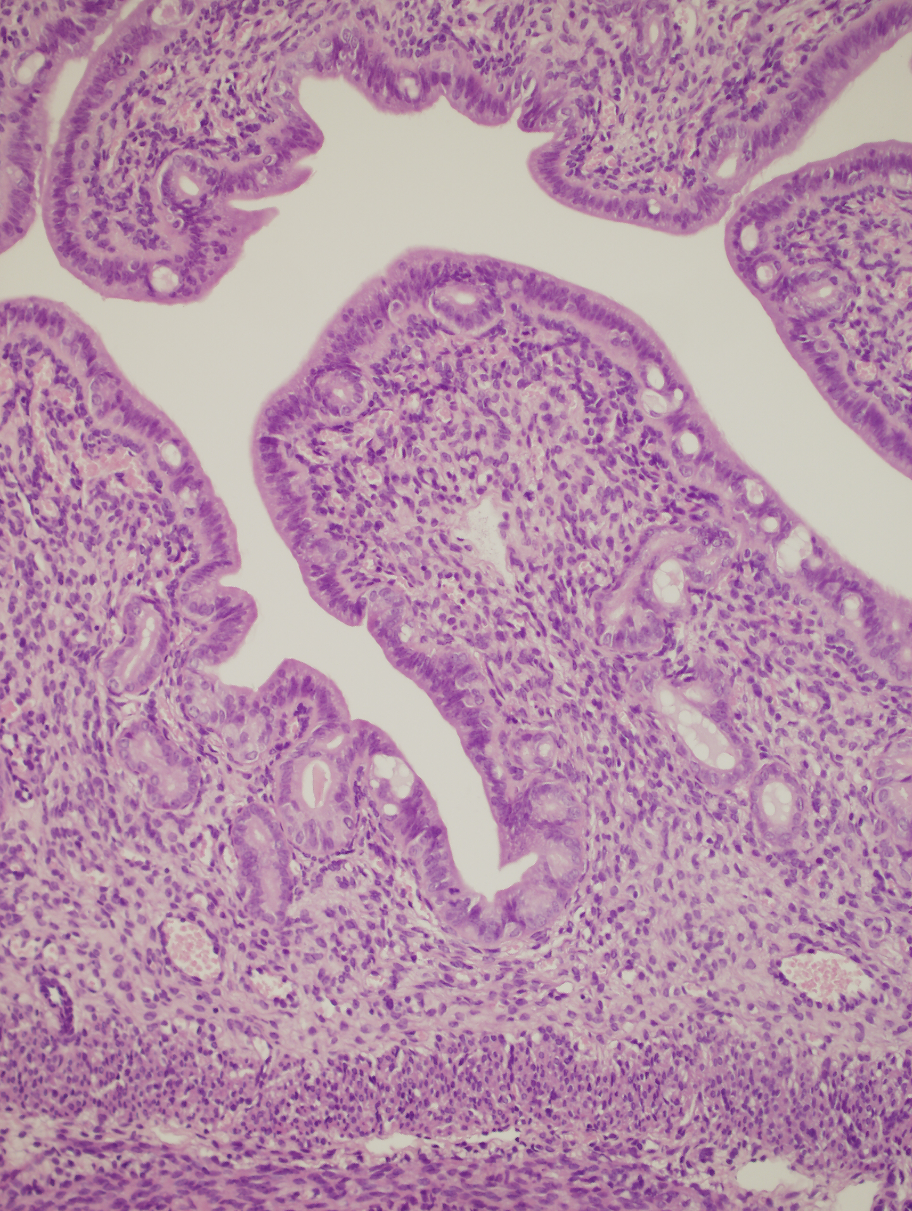 Fasting-mimicking diet and hormone therapy induce breast cancer regression