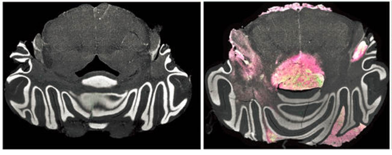 Tackling gliomas with CAR-T cells