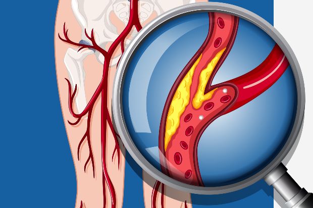 Stroke and the importance of acting FAST