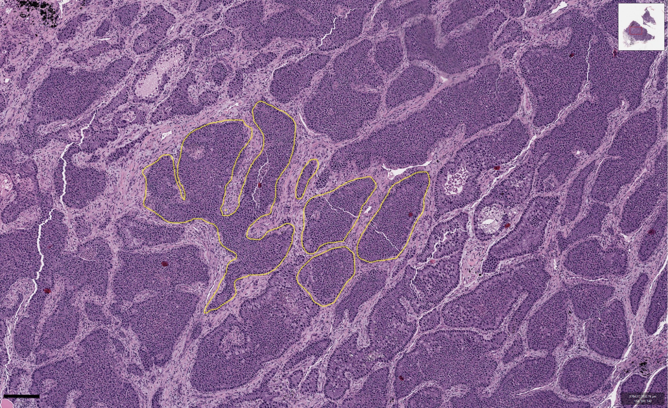 Tumour evolution: a tale of dispersal and interaction